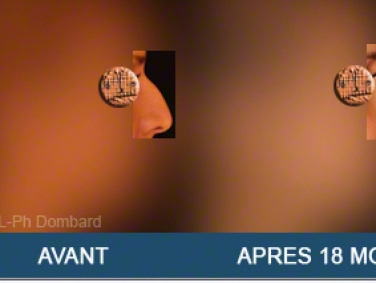 Chirurgie esthétique Rhinoplastie Primaire par spécialiste chirurgien du nez