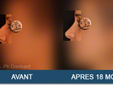 Chirurgie esthétique Rhinoplastie Primaire par spécialiste chirurgien du nez