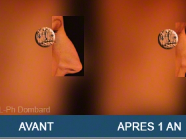 Chirurgie esthétique Rhinoplastie Primaire par spécialiste chirurgien du nez