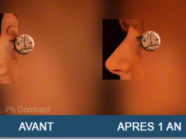 Chirurgie esthétique Rhinoplastie Primaire par spécialiste chirurgien du nez