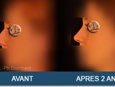 Chirurgie esthétique Rhinoplastie Primaire par spécialiste chirurgien du nez