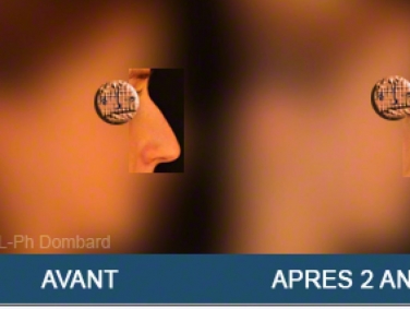 Chirurgie esthétique Rhinoplastie Primaire par spécialiste chirurgien du nez