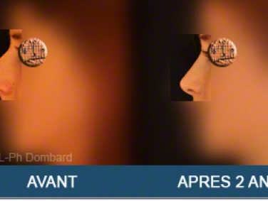 Chirurgie esthétique Rhinoplastie Primaire par spécialiste chirurgien du nez