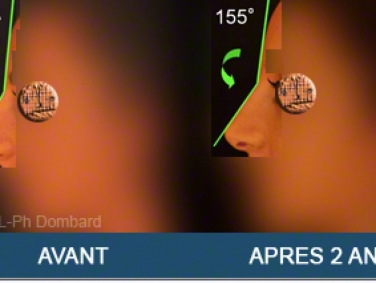 Chirurgie esthétique Rhinoplastie Primaire par spécialiste chirurgien du nez