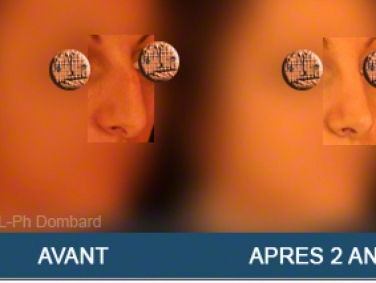Chirurgie esthétique Rhinoplastie Primaire par spécialiste chirurgien du nez