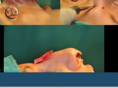 Chirurgie esthétique Rhinoplastie Primaire par spécialiste chirurgien du nez