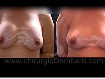 Avant - Après. Vue de face. Prothèse rétro-musculaire ronde. Correction prothèse (plus petites) anatomique rétro-glandulaire. Seins Proteses mammaire