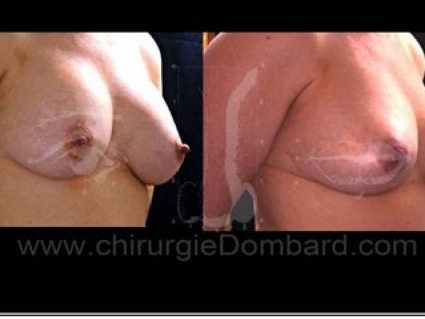 Avant - Après. Vue 3/4. Prothèse rétro-musculaire ronde. Correction prothèse (plus petites) anatomique rétro-glandulaire. Seins Proteses mammaire