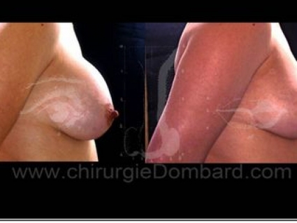 Avant - Après. Vue de profile. Prothèse rétro-musculaire ronde. Correction prothèse (plus petites) anatomique rétro-glandulaire. Seins Proteses mammaire
