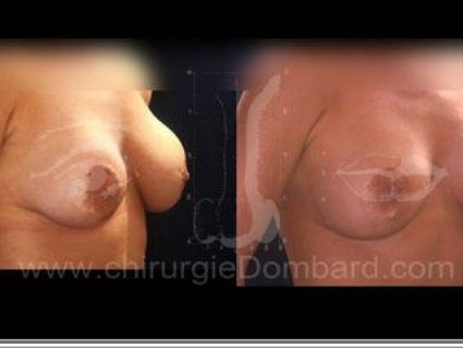 Séquelles chirurgie péri-aréolaire. Correction.Seins Proteses mammaire