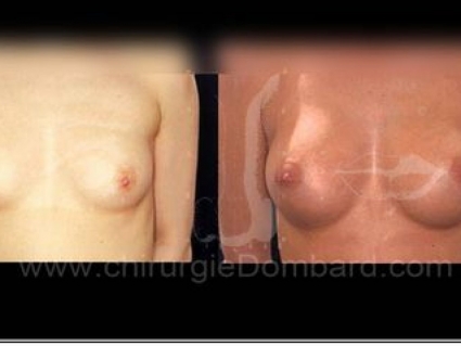 Avant-Après. Vue de face. 225cc. Prothèse ronde rétro-glandulaire. Résultat à 1 an. Seins Proteses mammaire