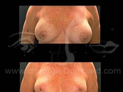 Coque sur prothèse ronde. Correction + prothèse anatomique rétro-glandulaire. Seins Proteses mammaire
