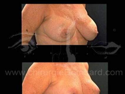 Coque sur prothèse ronde. Correction + prothèse anatomique rétro-glandulaire. Seins Proteses mammaire