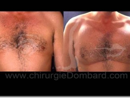 Avant - Après. Vue de face. Implants pectoraux. Face profil. 600gr. 2 ans