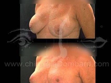 Coque sur prothèse ronde. Correction + prothèse anatomique rétro-glandulaire. Seins Proteses mammaire