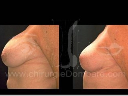 Coque sur prothèse ronde. Correct ion + prothèse anatomique rétro-glandulaire.Seins Proteses mammaire