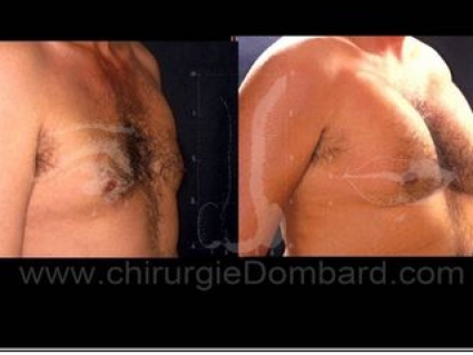 Avant - Après. Vue 3/4. Implants pectoraux. Face profil. 600gr. 2 ans.