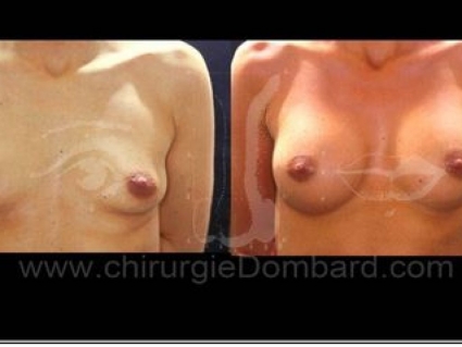 Vue avant - Après. Implants anatomiques. 315cc. 1 an.Seins Proteses mammaire