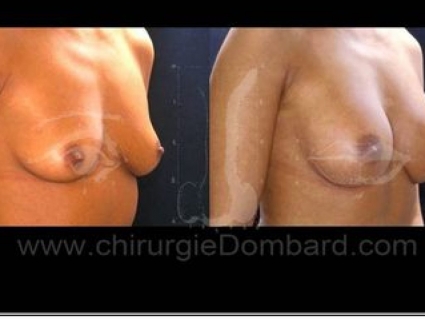 Avant - Après. Vue 3/4. Implants anatomiques. Rétro-glandulaire. 2 ans. Seins Proteses mammaire