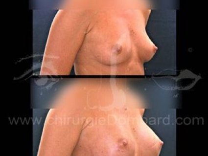 Prothèse ronde rétro-musculaire. 2 mois. Seins Proteses mammaire
