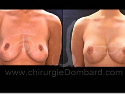 Séquelles de chirurgie mammaire. Correction + prothèse.Seins Proteses mammaire