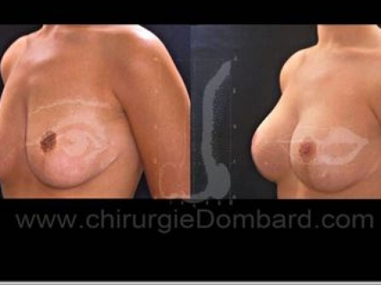 Séquelles de chirurgie mammaire. Correction + prothèse.Seins Proteses mammaire
