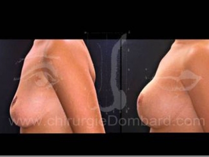 Séquelles de chirurgie mammaire. Correction + prothèse. Seins Proteses mammaire