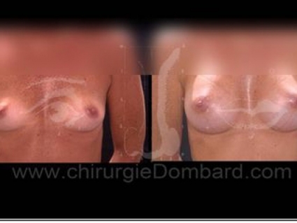 Avant - Après. Vue de face. Implants rond. Rétro-musculaire. 3 mois. Seins Proteses mammaire