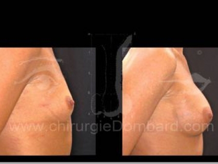 Prothèses rétro-glandulaire anatomiques. Seins Proteses mammaire