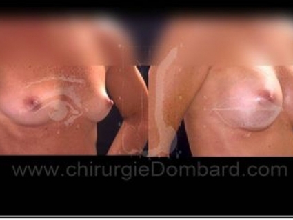 Avant - Après. Vue 3/4. Implants rond. Rétro-musculaire. 3 mois. Seins Proteses mammaire