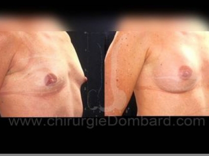 Avant - Après. Vue 3/4. Implants anatomiques rétro-glandulaire. Seins Proteses mammaire