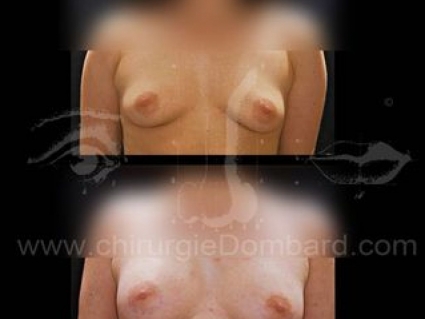 Prothèse anatomique rétroglandulaire. Seins Proteses mammaire