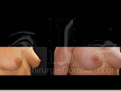 Prothèse anatomique rétroglandulaire. Seins Proteses mammaire