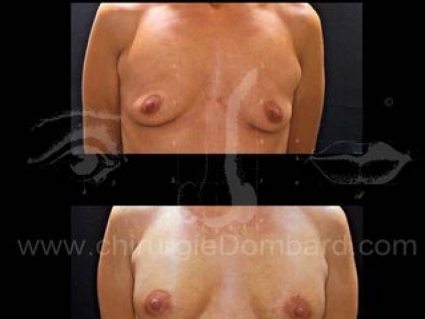 Prothèse ronde rétro-musculaire. 2 mois Post-opératoire.