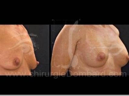 Prothèse ronde rétro-musculaire. 2 mois Post-opératoire.