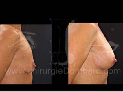 Prothèse ronde rétro-musculaire. 2 mois Post-opératoire. Seins Proteses mammaire