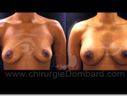 Avant - Après. Vue de face. Prothèses ronde rétro-musculaire.Seins Proteses mammaire