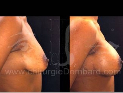 Avant - Après. Vue de profile. Prothèses ronde rétro-musculaire.Seins Proteses mammaire