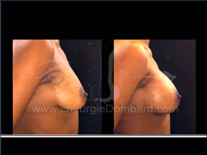 Avant - Après. Vue de profile. Prothèses ronde rétro-musculaire.Seins Proteses mammaire