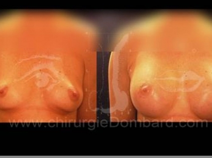 Avant - Après. Vue de face.  Prothèse ronde rétro-musculaire. Après 1 an.Seins Proteses mammaire