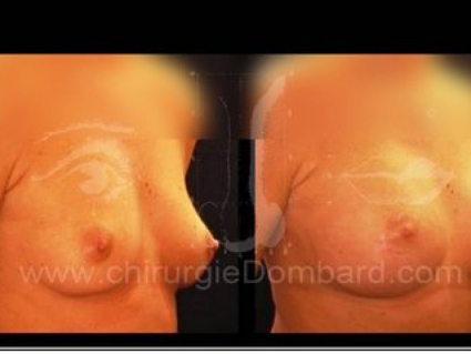 Avant - Après. Vue 3/4. Prothèse ronde rétro-musculaire. Après 1 an.Seins Proteses mammaire