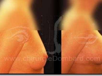 Avant - Après. Vue de profile. Prothèse ronde rétro-musculaire. Après 1 an. Seins Proteses mammaire