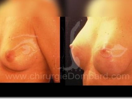 Avant - Après. Vue 3/4. Prothèse ronde rétro-musculaire. Après 1 an. Seins Proteses mammaire