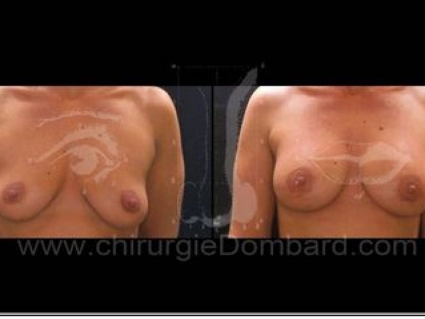 Avant - Après. Vue 3/4. Prothèse ronde rétro-musculaire. Après 1 an. Seins Proteses mammaire Seins Proteses mammaire