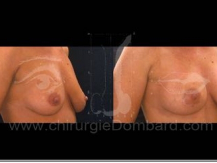 Avant - Après. Vue 3/4. Prothèse ronde rétro-musculaire. 2 mois.Seins Proteses mammaire