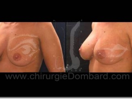 Avant - Après. Vue 3/4. Prothèse ronde rétro-musculaire. 2 mois. Seins Proteses mammaire