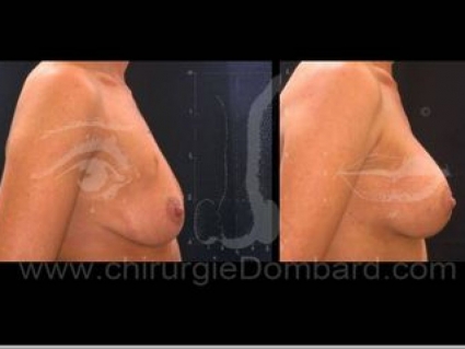 Avant - Après. Vue de profile. Prothèse ronde rétro-musculaire. 2 mois.Seins Proteses mammaire