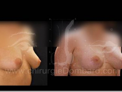 Avant - Après. Vue 3/4. Prothèse ronde rétro-musculaire. 1 an. Seins Proteses mammaire