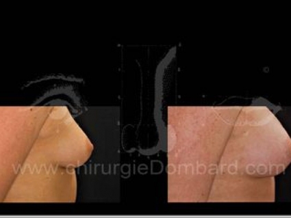 Avant - Après. Vue de profile. Prothèse ronde rétro-musculaire. 1 an. Seins Proteses mammaire