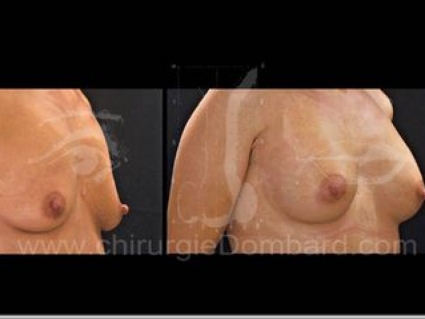Avant - Après. Vue 3/4. Prothèse ronde rétro-musculaire. 1 an. Seins Proteses mammaire